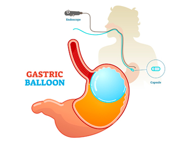 Gastric Balloon